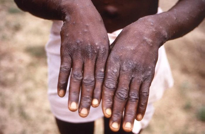 Một bệnh nhân bị mắc bệnh đậu mùa khỉ ở Nigeria. Ảnh: THE GUARDIAN Một bệnh nhân bị mắc bệnh đậu mùa khỉ ở Nigeria. Ảnh: THE GUARDIAN