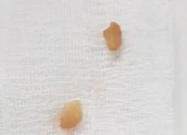 Kịp thời cứu bé trai 2 tuổi bị hóc hạt đậu phộng khi ăn xôi