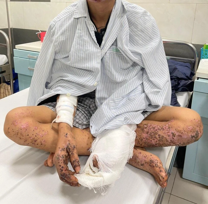 Bệnh nhân nhập viện trong tình trạng bất tỉnh, toàn thân cháy sém và nhiều tổn thương. Ảnh: BVCC Bệnh nhân nhập viện trong tình trạng bất tỉnh, toàn thân cháy sém và nhiều tổn thương. Ảnh: BVCC