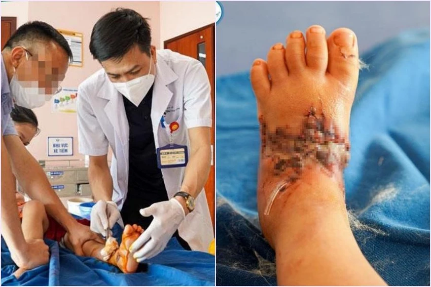 Các bác sĩ xác định bàn chân phải của bệnh nhi bị dập nát, vỡ 2 cổ xương bàn II- III, đứt gân duỗi ngón I-II-III, khuyết hổng da lộ gân mu chân. Ảnh: BV Các bác sĩ xác định bàn chân phải của bệnh nhi bị dập nát, vỡ 2 cổ xương bàn II- III, đứt gân duỗi ngón I-II-III, khuyết hổng da lộ gân mu chân. Ảnh: BV