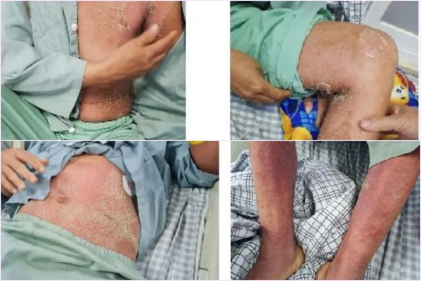 Hình ảnh bệnh nhân nhiễm liên cầu lợn trước và sau điều trị.