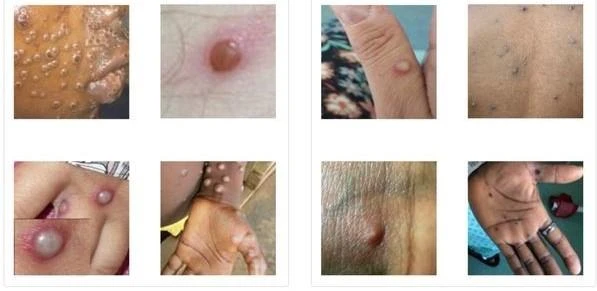 Các biểu hiện bệnh đậu mùa khỉ thể hiện trên da.