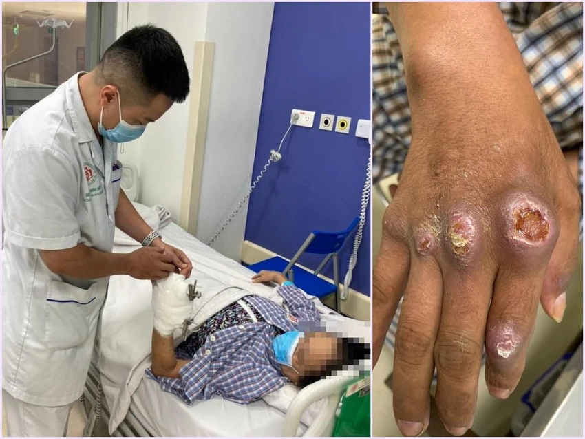 Nhiều trường hợp người bệnh bị biến chứng bàn tay, cổ tay do sử dụng tiêm thuốc giảm đau trong điều trị đau khớp. Ảnh: BV Nhiều trường hợp người bệnh bị biến chứng bàn tay, cổ tay do sử dụng tiêm thuốc giảm đau trong điều trị đau khớp. Ảnh: BV