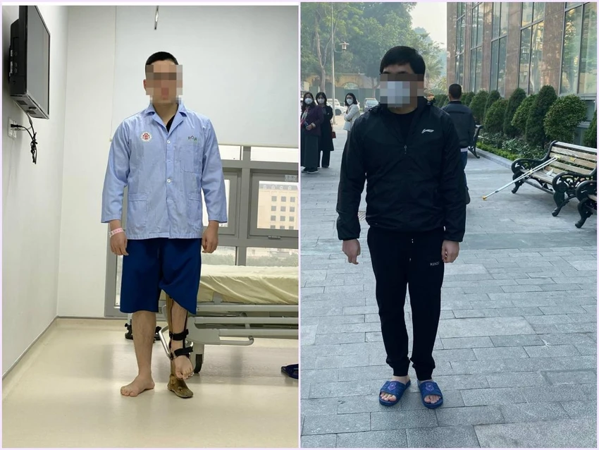 Hình ảnh chân của chàng trai 23 tuổi trước (trái) và sau chỉnh sửa (phải). Ảnh: BVCC Hình ảnh chân của chàng trai 23 tuổi trước (trái) và sau chỉnh sửa (phải). Ảnh: BVCC