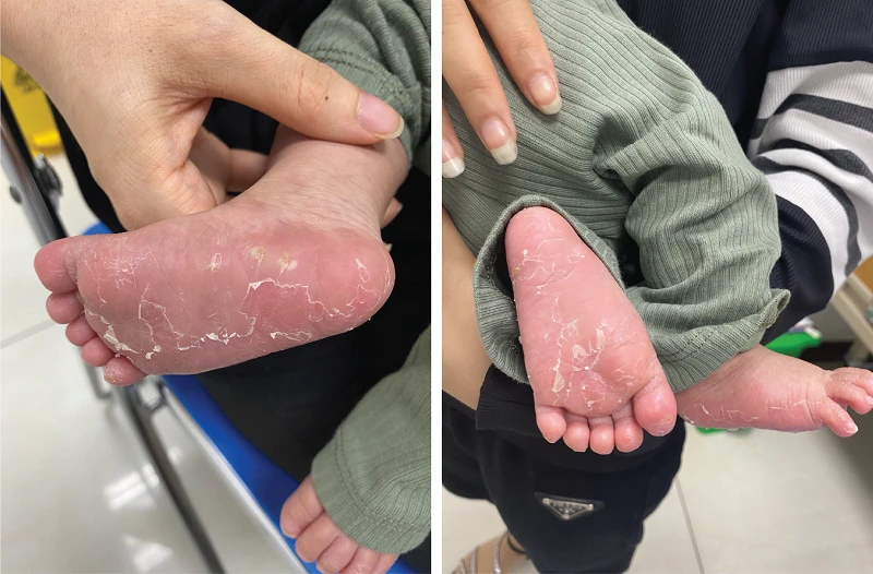 Bé bị bong da tay, da chân ngay sau sinh. Ảnh: BV Bé bị bong da tay, da chân ngay sau sinh. Ảnh: BV