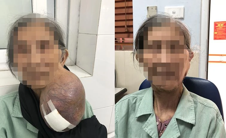 Cuộc phẫu thuật thành công mang lại niềm vui cho cụ bà 85 tuổi. Ảnh: BV