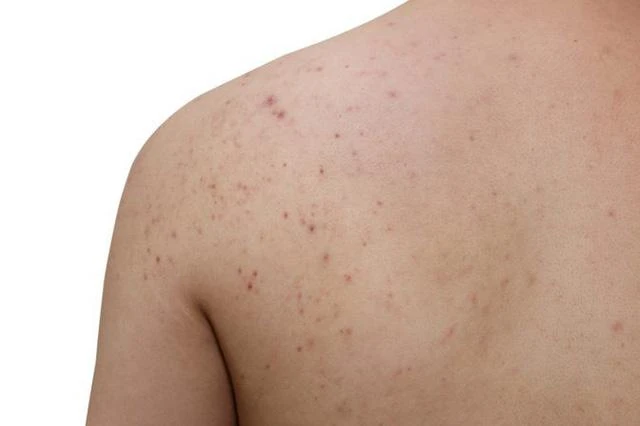 Mụn trứng cá ở lưng là một thể của bệnh lý trứng cá.