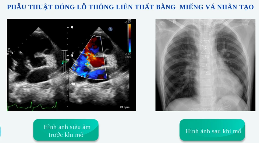 Hình ảnh lỗ thông liên thất trước và sau khi mổ của bệnh nhi. Ảnh: BVCC Hình ảnh lỗ thông liên thất trước và sau khi mổ của bệnh nhi. Ảnh: BVCC