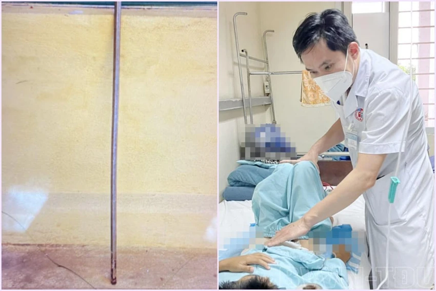 Thanh sắt (trái) và bệnh nhi sau khi được cấp chữa kịp thời. Ảnh: BVCC Thanh sắt (trái) và bệnh nhi sau khi được cấp chữa kịp thời. Ảnh: BVCC