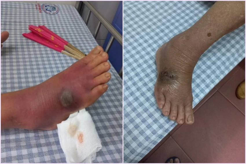 Hình ảnh khi người bệnh vào viện sưng tấy lan tỏa toàn bộ mu chân lên cổ chân, tại trung tâm vết cắn đang có dấu hiệu hoại tử ướt và kết quả sau 5 ngày điều trị, giảm sưng nề, viêm tấy mu chân. Ảnh: BV