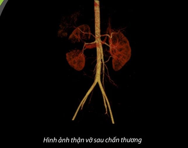 Hình ảnh thận vỡ sau chấn thương. Hình ảnh thận vỡ sau chấn thương.