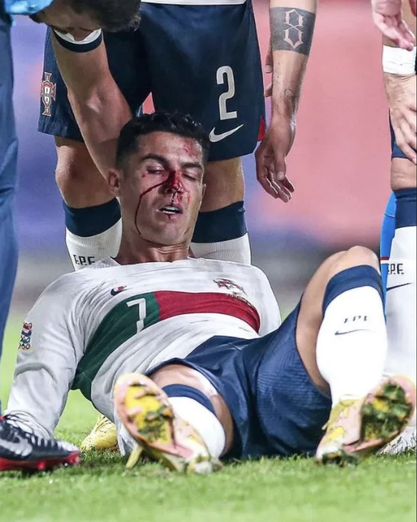 Khuôn mặt bê bết máu của Ronaldo. ẢNH: EPA Khuôn mặt bê bết máu của Ronaldo. ẢNH: EPA