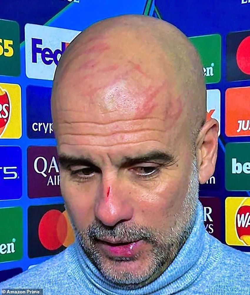 Pep Guardiola xuất hiện với nhiều vết thương gây chấn động,Pep Guardiola