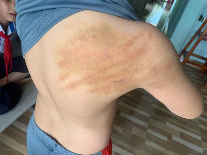 Cháu TTA bị đánh bầm vai. Ảnh gia đình cháu A cung cấp. Cháu TTA bị đánh bầm vai. Ảnh gia đình cháu A cung cấp.