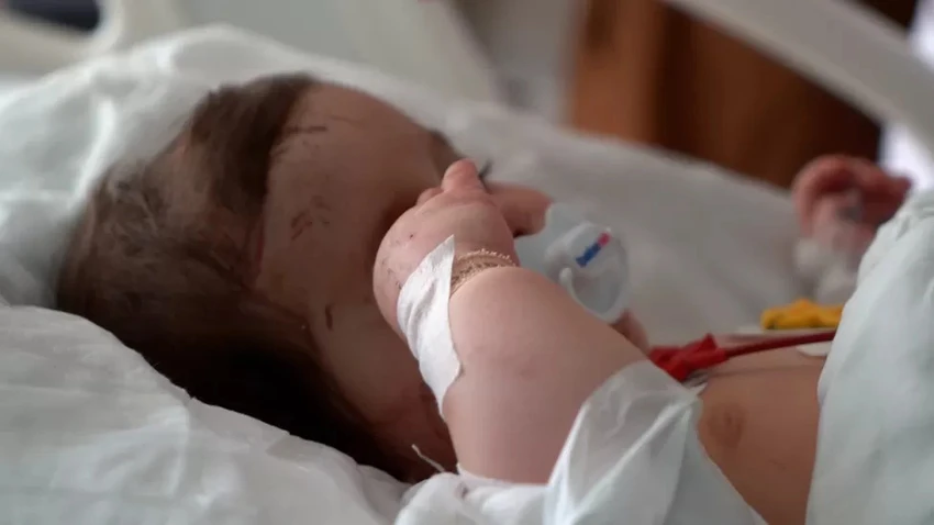 Bé gái 6 tháng tuổi với một bên mặt bị bầm tím trong bệnh viện Adana. Ảnh: BBC Bé gái 6 tháng tuổi với một bên mặt bị bầm tím trong bệnh viện Adana. Ảnh: BBC