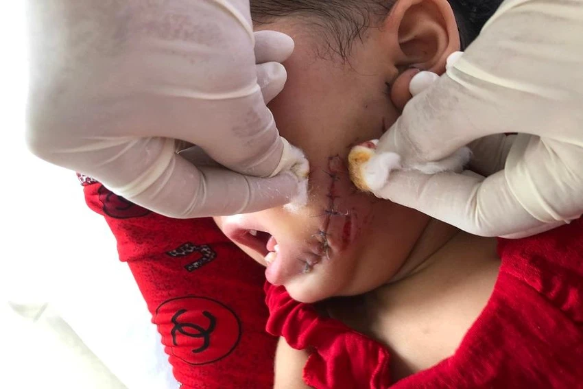 Vết thương trên mặt bé B.N.M sau 4 ngày điều trị tại Bệnh viện Sản- Nhi Cà Mau. Ảnh: CTV. Vết thương trên mặt bé B.N.M sau 4 ngày điều trị tại Bệnh viện Sản- Nhi Cà Mau. Ảnh: CTV.